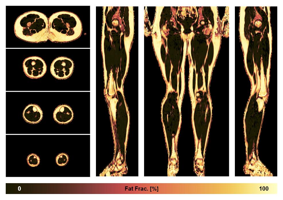 The fat fraction of the lower extremity obtained from the dixon reconstruction for muscle water fat quantification.